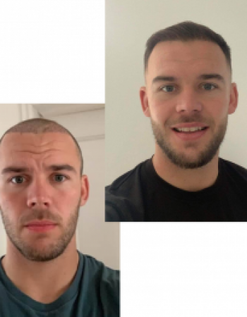 Baruch Hair Loss Clinic